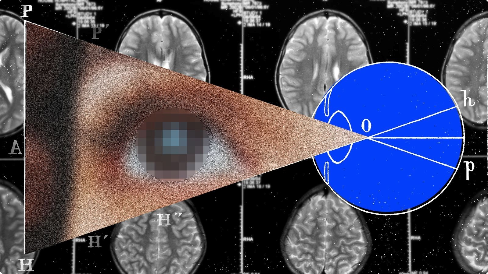 Brain Implants